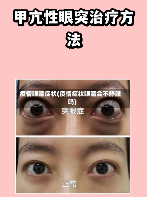 疫情眼睛症状(疫情症状眼睛会不舒服吗)-第3张图片