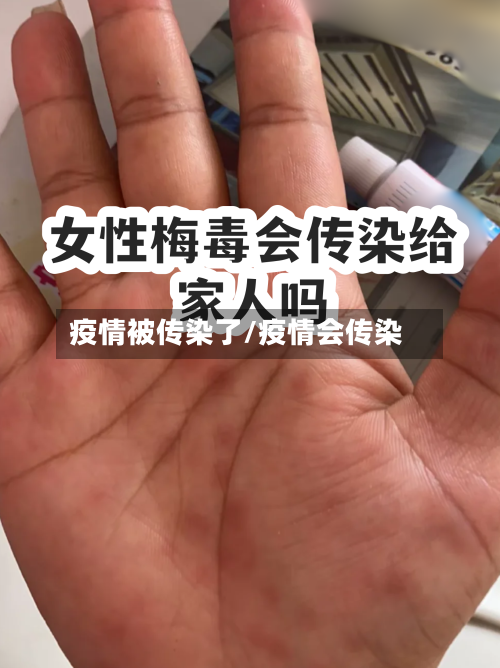 疫情被传染了/疫情会传染-第2张图片