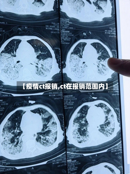 【疫情ct报销,ct在报销范围内】-第3张图片