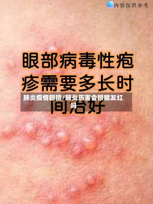 肺炎疫情眼镜/肺炎历害会眼睛发红吗-第2张图片