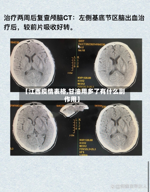 【江西疫情表格,甘油用多了有什么副作用】-第2张图片