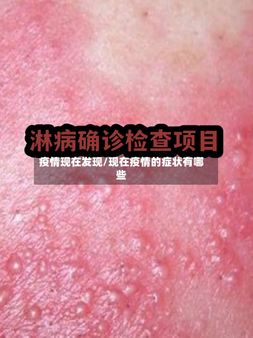 疫情现在发现/现在疫情的症状有哪些-第2张图片