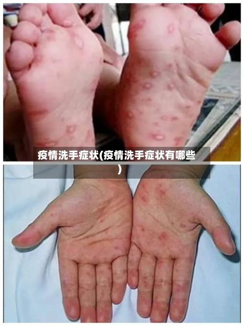 疫情洗手症状(疫情洗手症状有哪些)